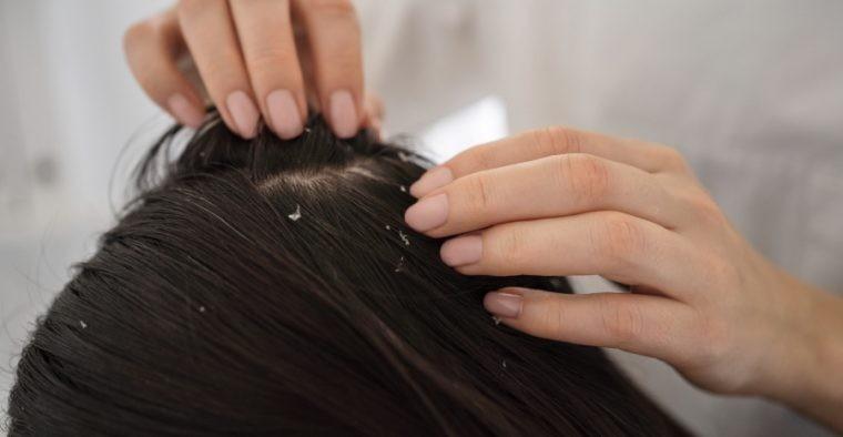 Beat Annoying Winter Hair Fall: 8 Powerful Tips for a Healthier, Stronger Scalp
